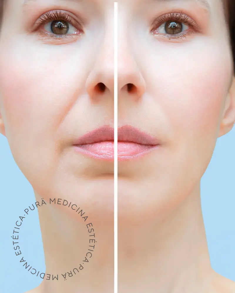 Tratamientos faciales y corporales con Acido Hialuronico